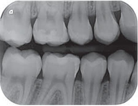 Técnica Interproximal