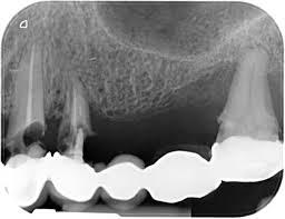 Técnica Periapical